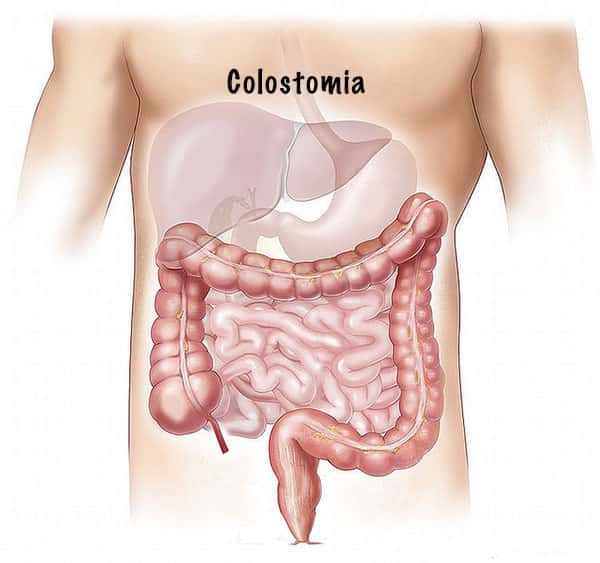 Colostomia, abdômen