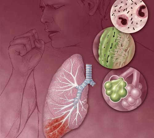 Pneumonia e Tuberculose